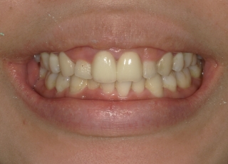 Before