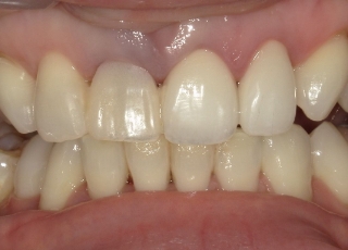 Before